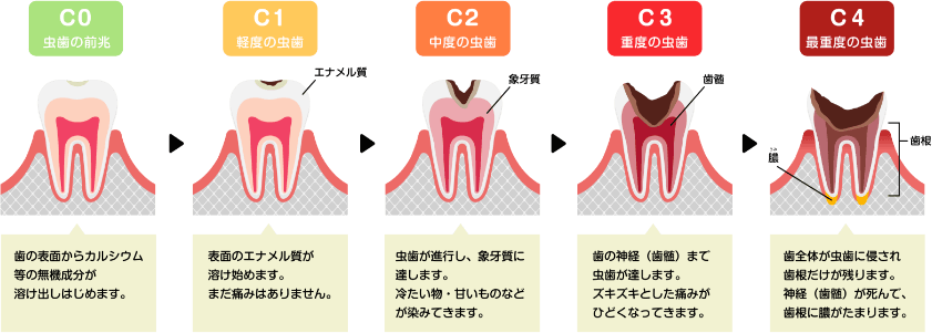 むし歯の進行と主な症状